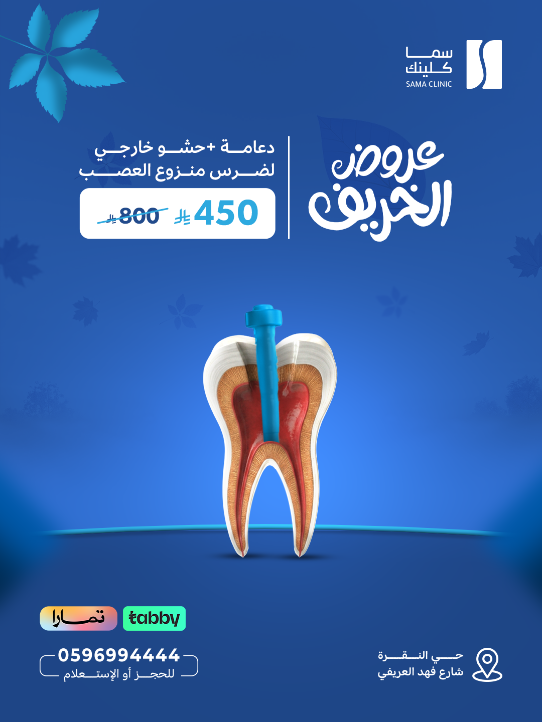 دعامة + حشو خارجي لضرس منزوع العصب